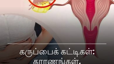 கருப்பைக் கட்டிகள்: காரணங்கள், அறிகுறிகள்