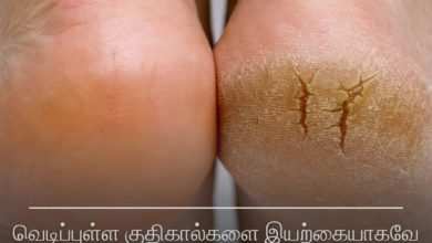 வெடிப்புள்ள குதிகால்