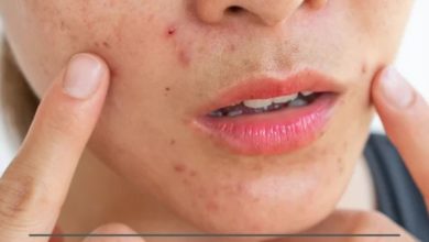 முகப்பரு