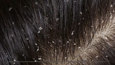 பொடுகு பிரச்சனை