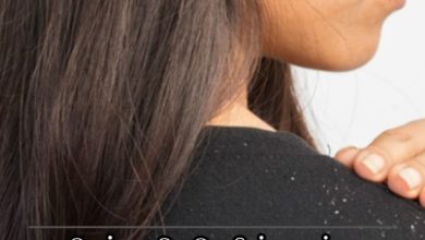 வெள்ளை பொடுகு